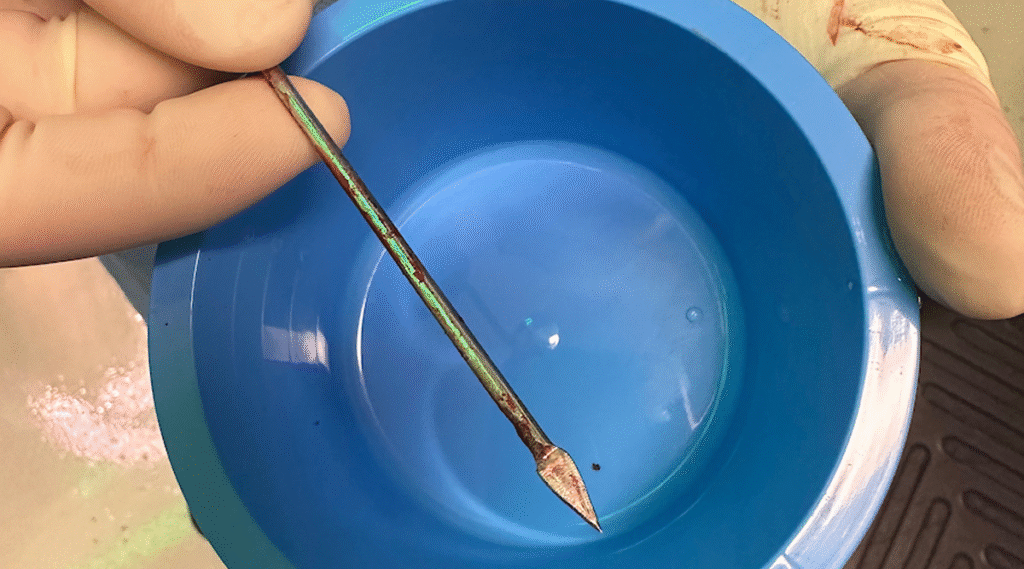 Image of the blow dart removed from the 7 year old girl.