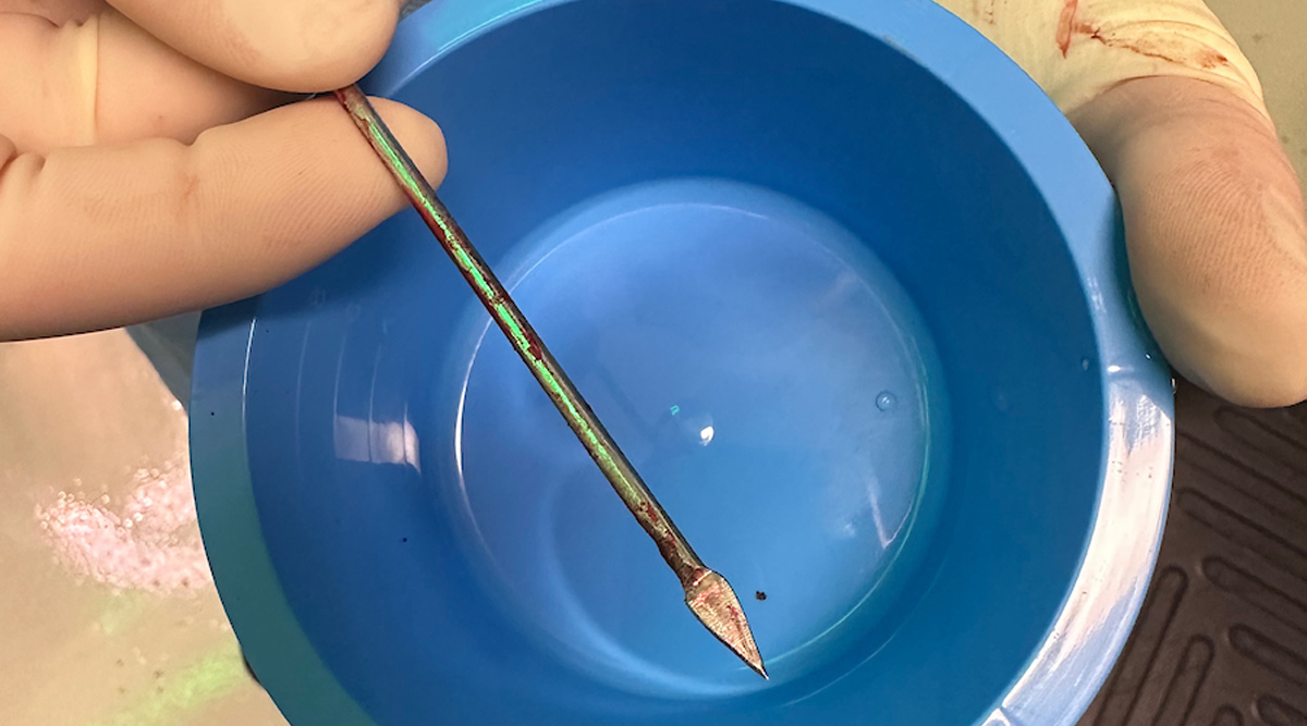 Image of the blow dart removed from the 7 year old girl.